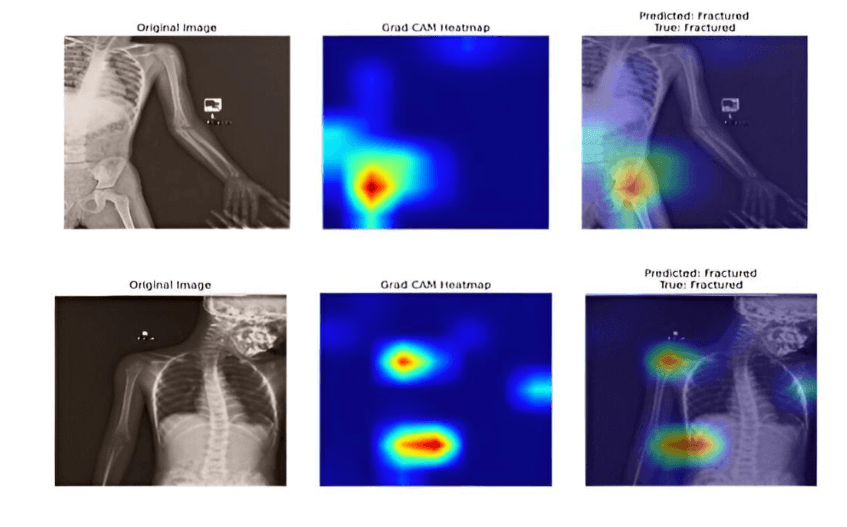 Visión Artificial en Traumatología: Detectando Fracturas Ocultas Cuando el Ojo Humano Falla.