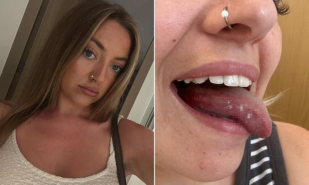 Woman, 25, spent a YEAR battling mysterious mouth ulcers, only to learn they were symptom of oral cancer