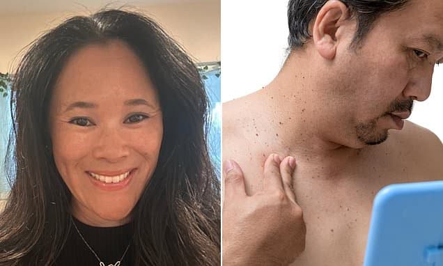 Doctors dismissed my unsightly skin tags as cosmetic nuisance... but they were an early warning sign of a hidden health issue that hits millions of Americans