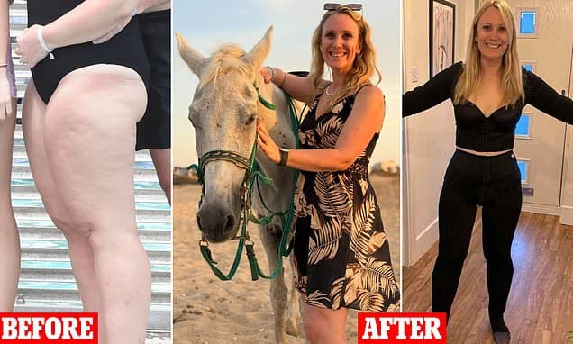 I always hated my large legs and the fat wouldn't budge no matter what I did. Then I discovered the condition that was really to blame... and found a solution that changed my life and let me squeeze into jeans