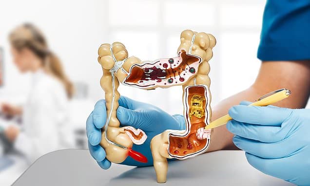 New young cancer bombshell: Rectal cancer deaths accelerating at an alarming pace in millennials... the signs to watch out for as experts warn: 'It's striking earlier and killing faster'