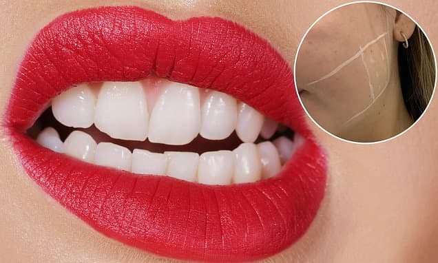 I spent years waking up with splintering headaches from grinding my teeth - then I tried Botox at 24