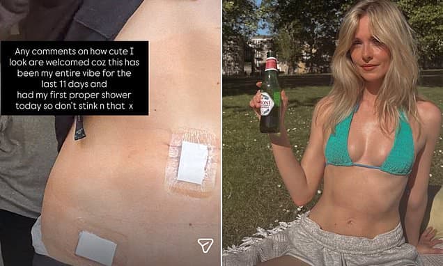 Diana Vickers wows in a green bikini top and reveals mystery health woe as she displays her bandaged body