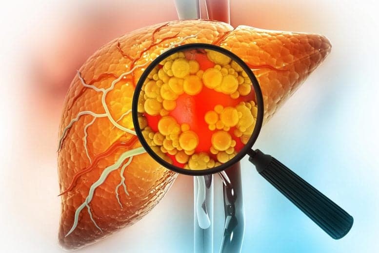 Scientists Find Way to Reverse Fatty Liver Disease Without Changing Diet